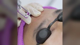 picosecond last tattoo verwijderen werkvideo
