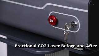 Laser CO2 fractionné avant et après – De vrais résultats