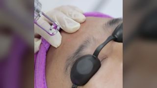 How to operate picolaser tattoo removal machine