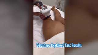 How is Velashape working？
